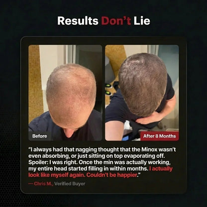 Hair Regrowth Accelerator Kit